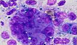 Un 30% de pacientes con cáncer de ovario resistente-refractario a platino responden a PM01183, de PharmaMar